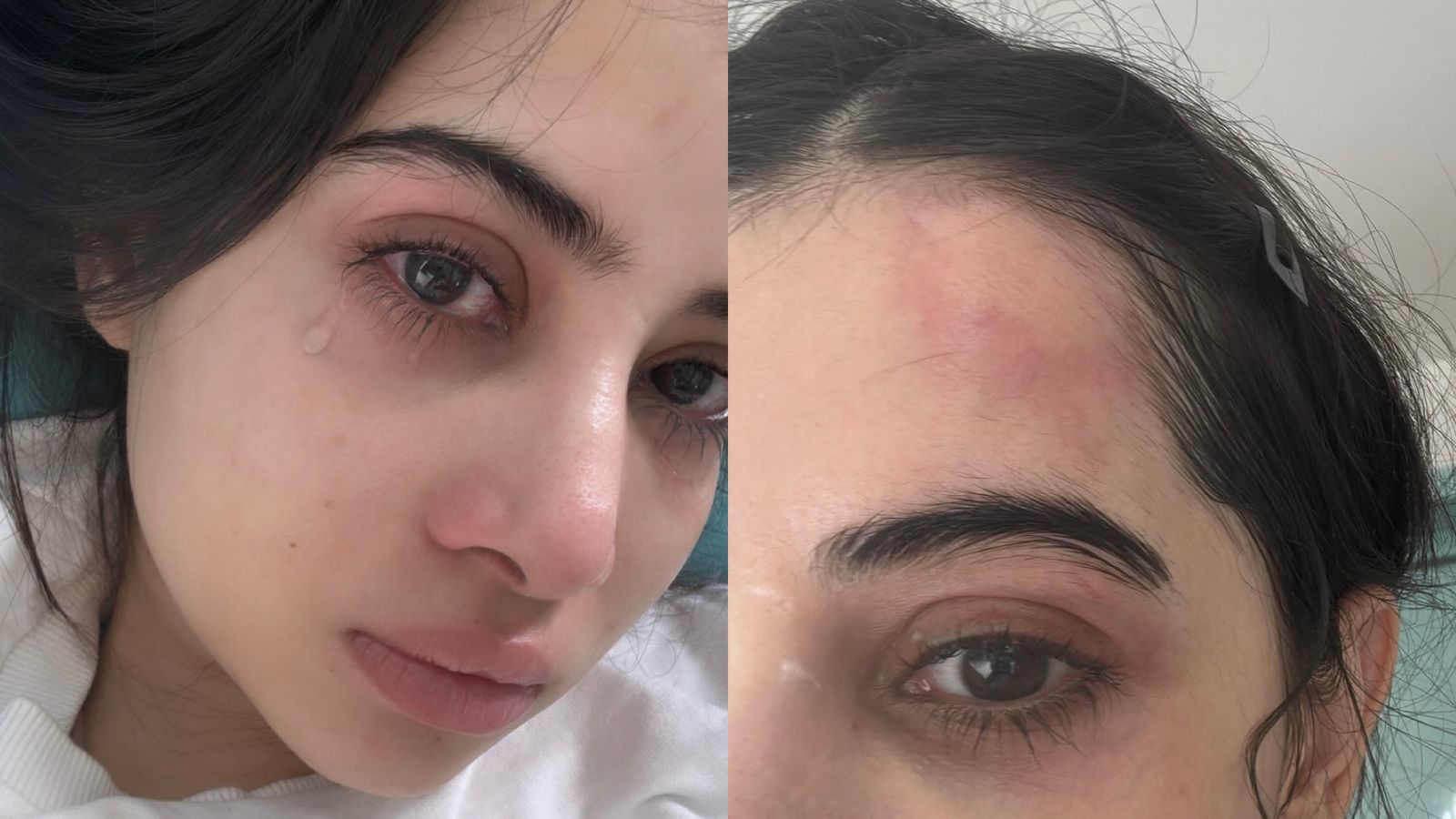 Urfi Javed Ki Roti Hui Aur Chehre Par Chot Wali Photos Viral